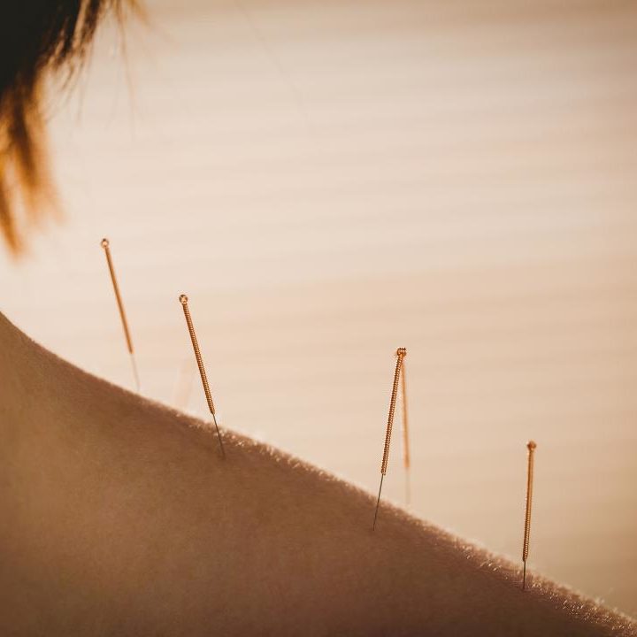 Acupuncture Needles in a ladies neck.
